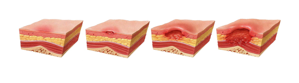 Yatak yarası evreleri